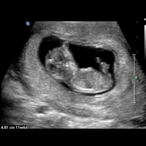 Limited OB First Trimester Ultrasound Training Bundle