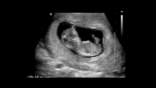 Limited OB First Trimester Ultrasound Training Bundle